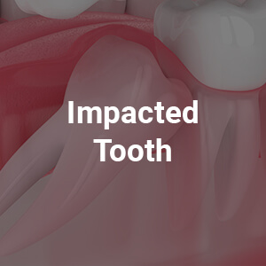Impacted Tooth